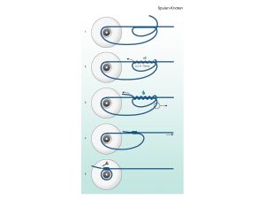 Angelknoten: Der Spulen-Knoten Spulen-Knoten